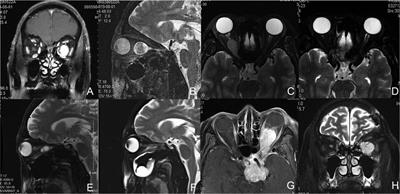 Comparative endoscopic techniques of medial rectus muscle retraction for approaching intraconal tumors: Our experience with five cases